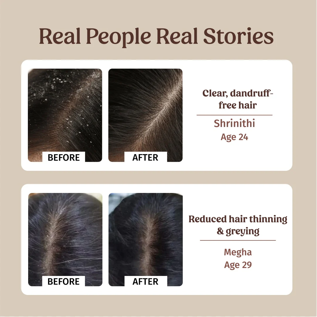Anti-dandruff Combo - Image 4