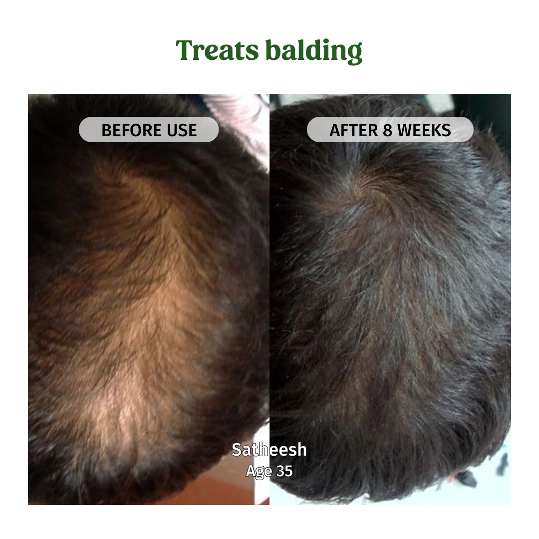 Hair Regrowth Oil - Image 4